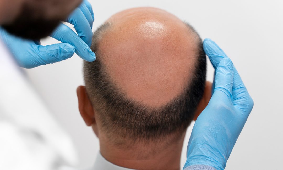 Adult hair loss with visible bald spot